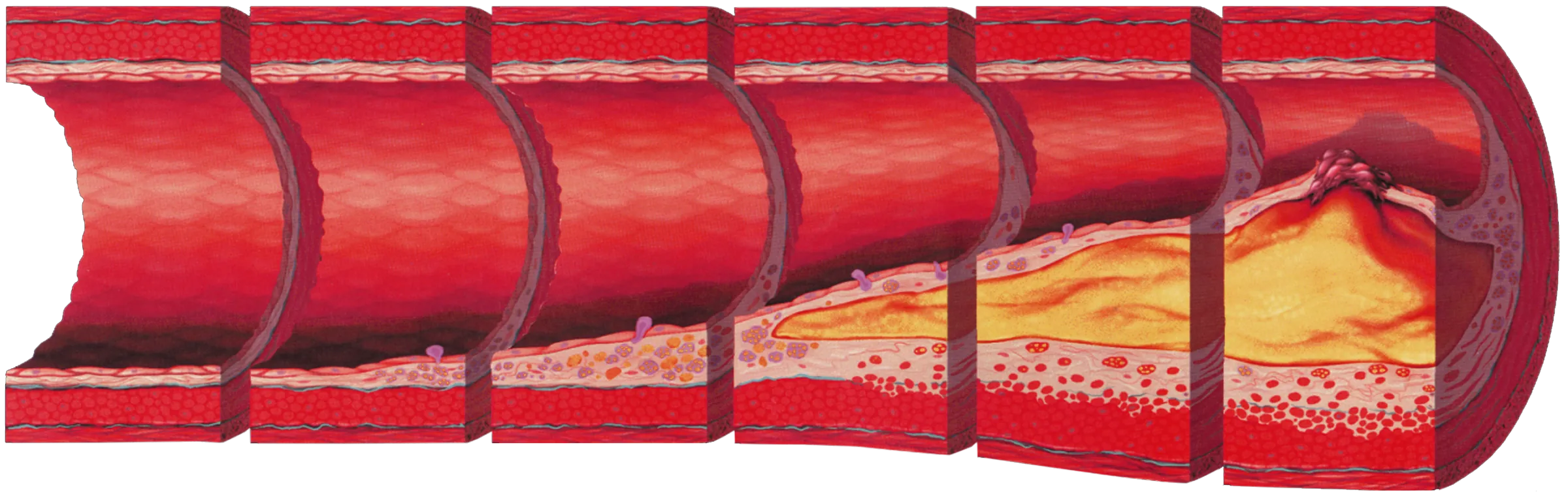 A coronary artery wall cut open in six stages from left to right: a clean wall, a small fatty streak, a growing plaque, a plaque with a yellow fatty core, and at the end a plaque whose thin cap has torn with a dark clot sitting on it.