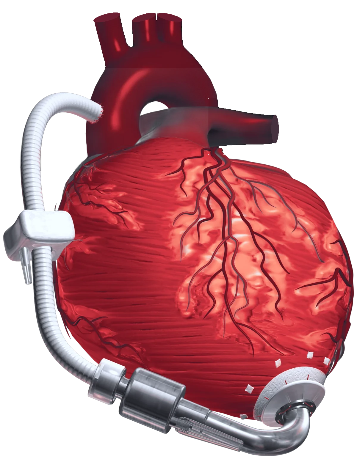 Illustration of a heart with a mechanical pump attached at the apex and a graft running to the aorta